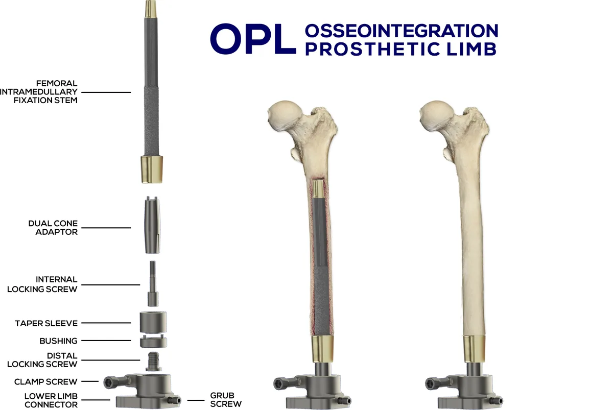 OPL — budowa implantu osseointegracyjnego