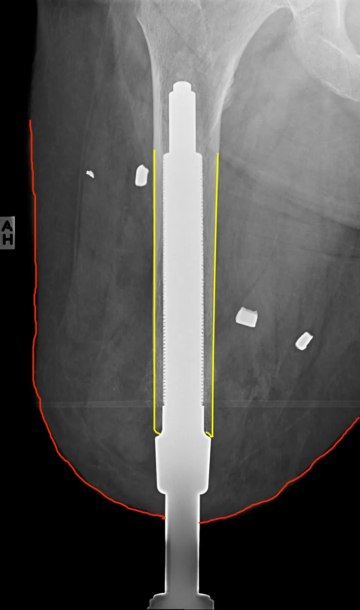 RTG implantu osseointegracyjnego w kości udowej