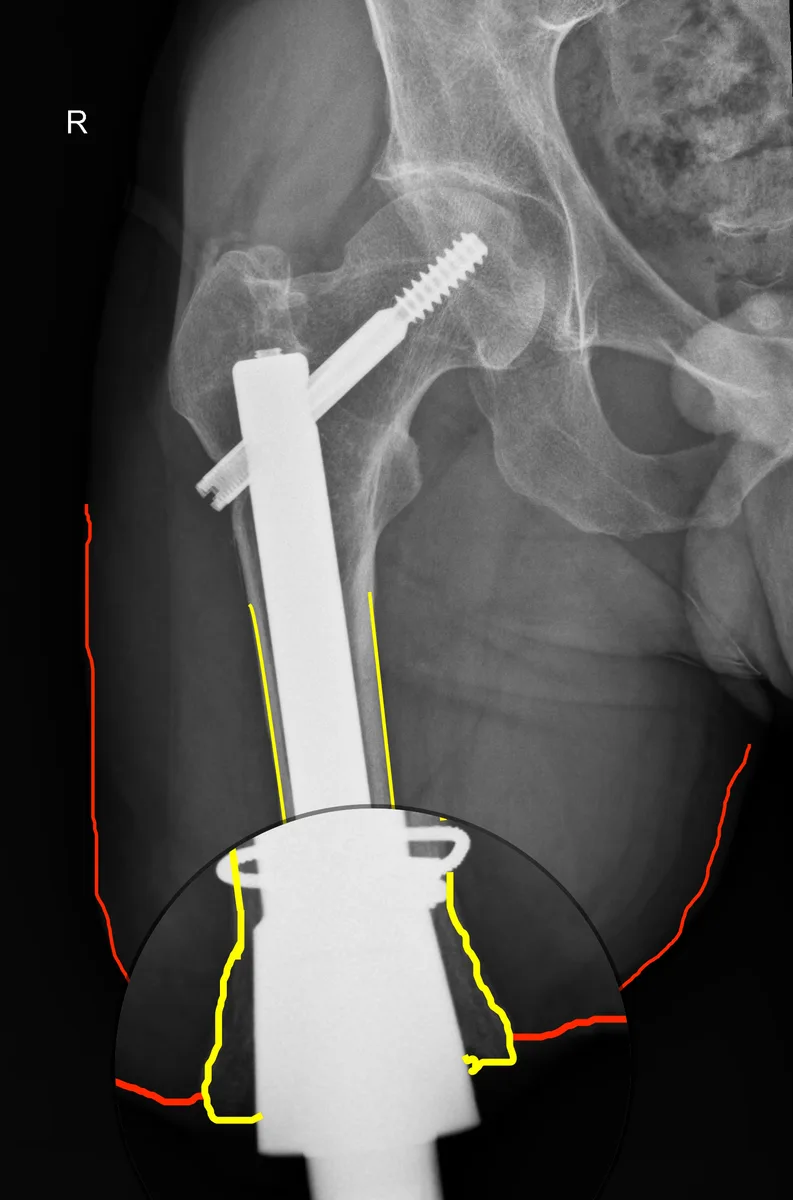 RTG implantu osseointegracyjnego u pacjenta po zespoleniu kości